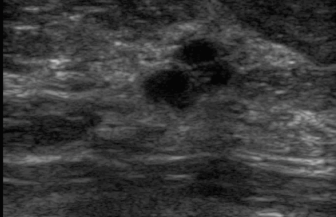 Medical diagram showing breast cyst drainage procedure under ultrasound guidance